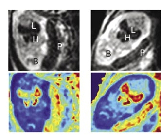 פעילות הגן המדווח פריטין בדופן כלי דם של עוברי עכברים. בשורה העליונה נראות הדמיות MRI של עכברה בהריון. חתכי האורך מראים את הכבד (L), לב (H), מוח (B) ושליה (P). בשורה התחתונה - מיפוי ערכי R2 שנמדדו באמצעות MRI. העוברים המהונדסים הנושאים את הגן המדווח (מימין) מראים פעילות גבוהה יותר של חלבון הפריטין (המתבטאת בצבעים אדומים יותר) בכבד ובלב, בהשוואה לאחיהם שאינם נושאים את הגן המדווח (משמאל)